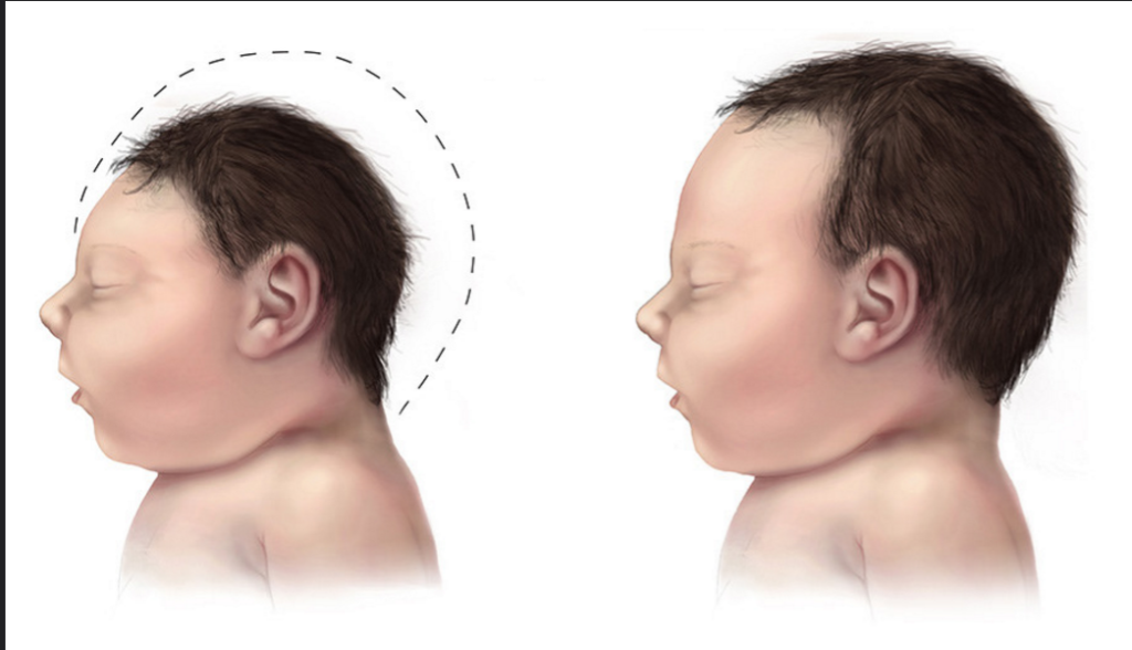 Birth Defect from Zika Virus