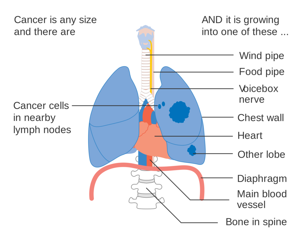 Lung Cancer Diagram