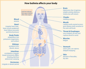 Bulimia Health Diagram