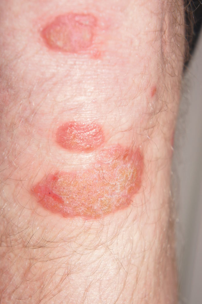 Psoriasis