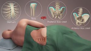  procedure of Bone Marrow.