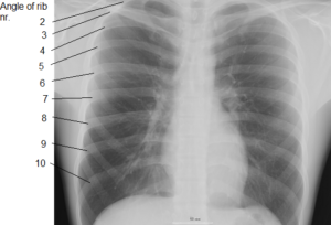 X-Ray view of human ribs