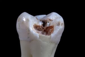 Photo of a decaying tooth