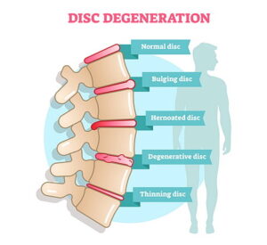 Illustration of spine/disc degeneration